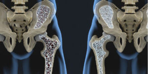 osteoporosi330
